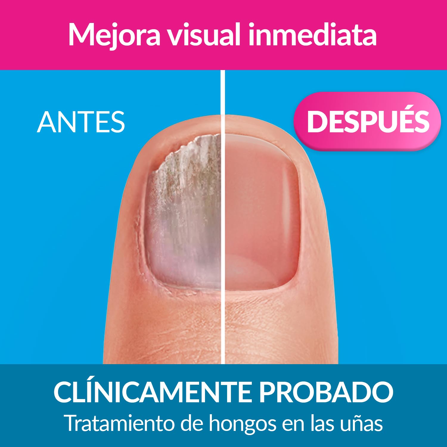 EXCILOR - Tratamiento De La Micosis De Las Uñas - Forte Color Nude - Fórmula Extra Fuerte - Tratamiento y Cobertura - Tratamiento para uñas 30 ml + Esmalte 8 ml - Clínicamente probado