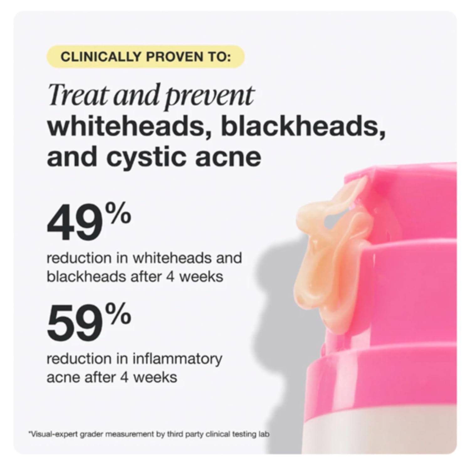 INNBEAUTY Project Acne Serum Medicated Treatment for Breakouts, Blackheads & Oil Control, 1 OZ (30ml)