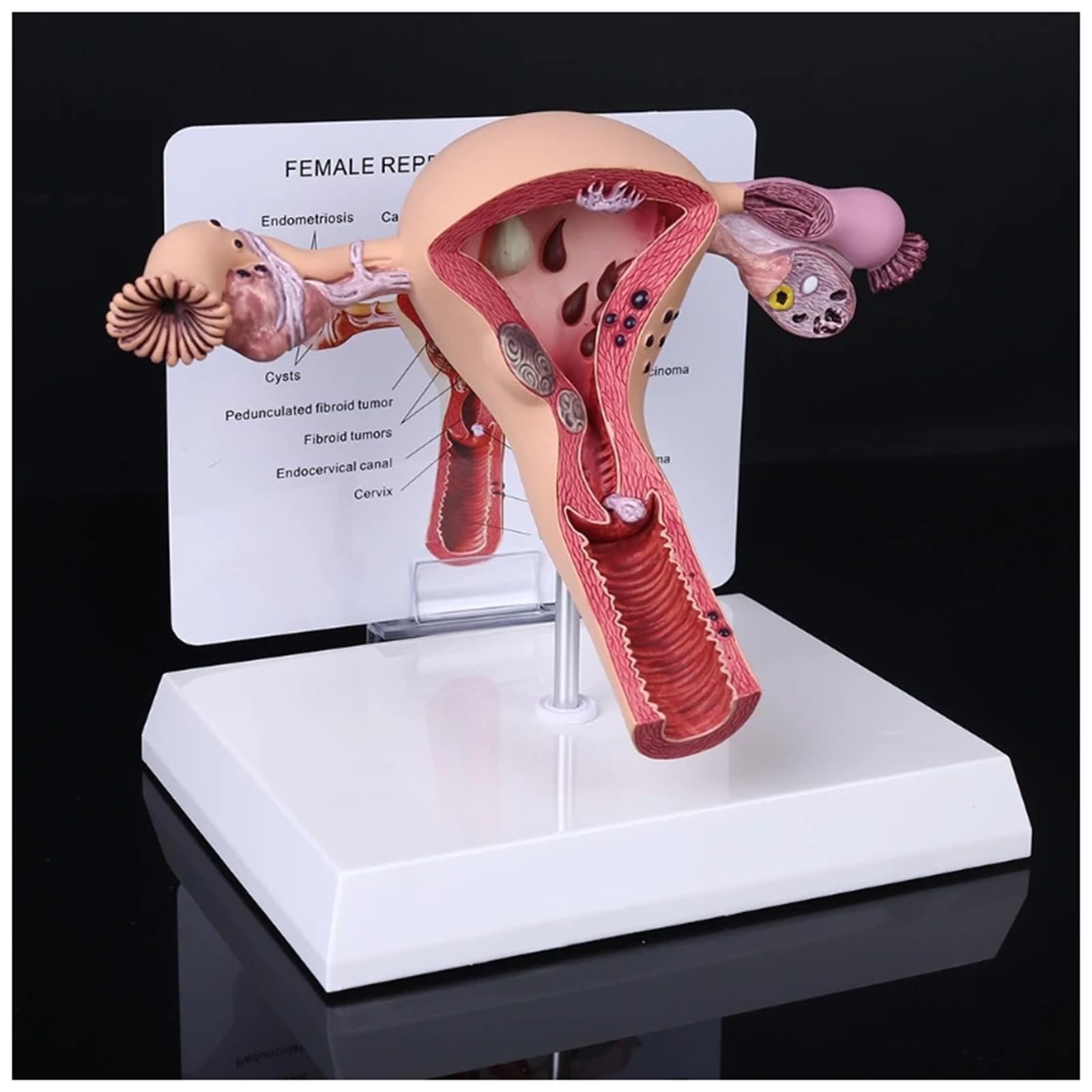 Gynecology Education Model Human Pathological Uterus Ovary Model - Life  Size Female Reproductive Organs With Medical Lesions - Teaching Learning  Tool Female Reproductive Organs Model, image size:1600x1600