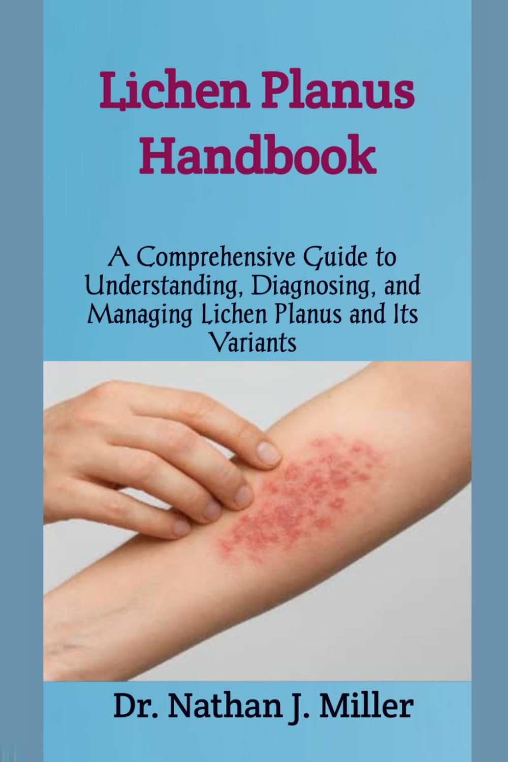 Lichen Planus Handbook: A Comprehensive Guide to Understanding, Diagnosing, and Managing Lichen Planus and Its Variants
