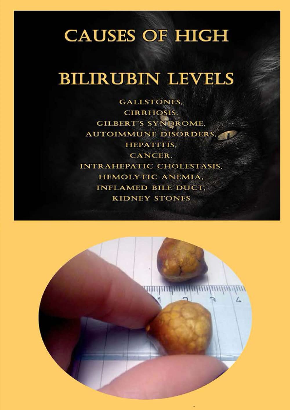 Buy Causes Of High Bilirubin Levels Gallstones, Cirrhosis, Gilbert’s