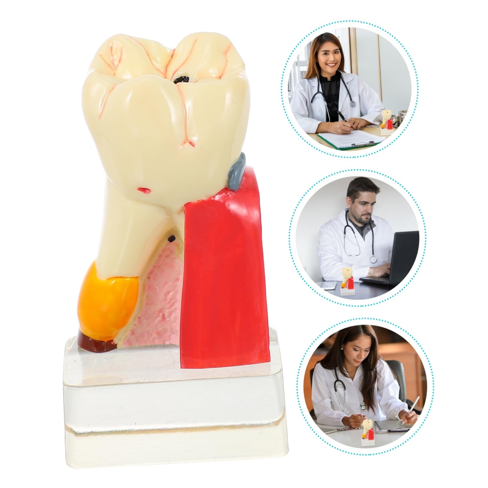 Alipis 4volte Modello di Carie Modello Anatomico di Carie per Studio e Ricerca Odontoiatrica Leggero e Portatile