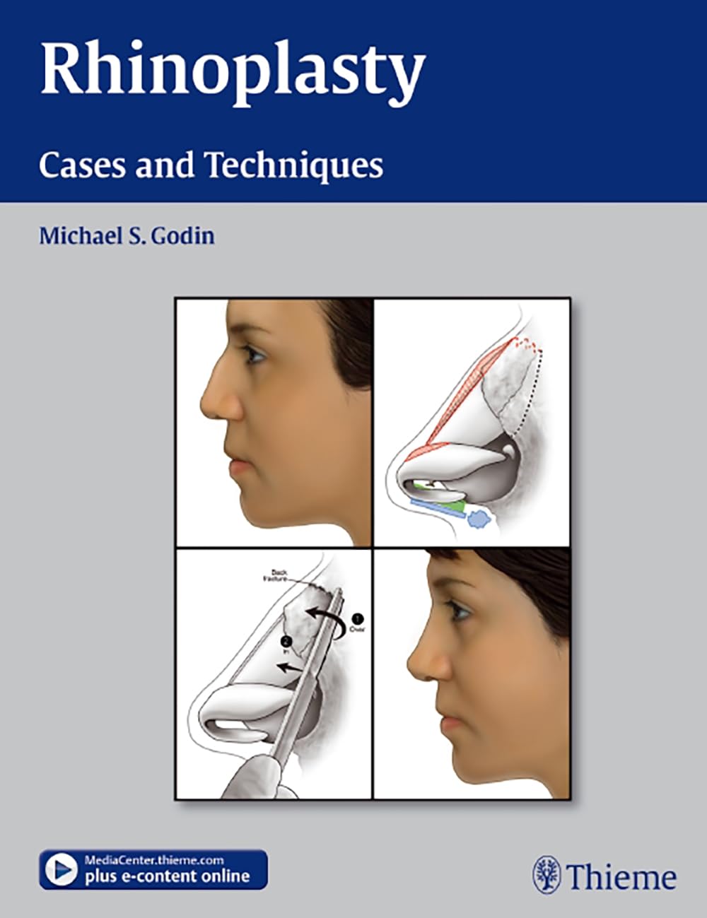 Buy Rhinoplasty - Cases and Techniques — BookShops.in