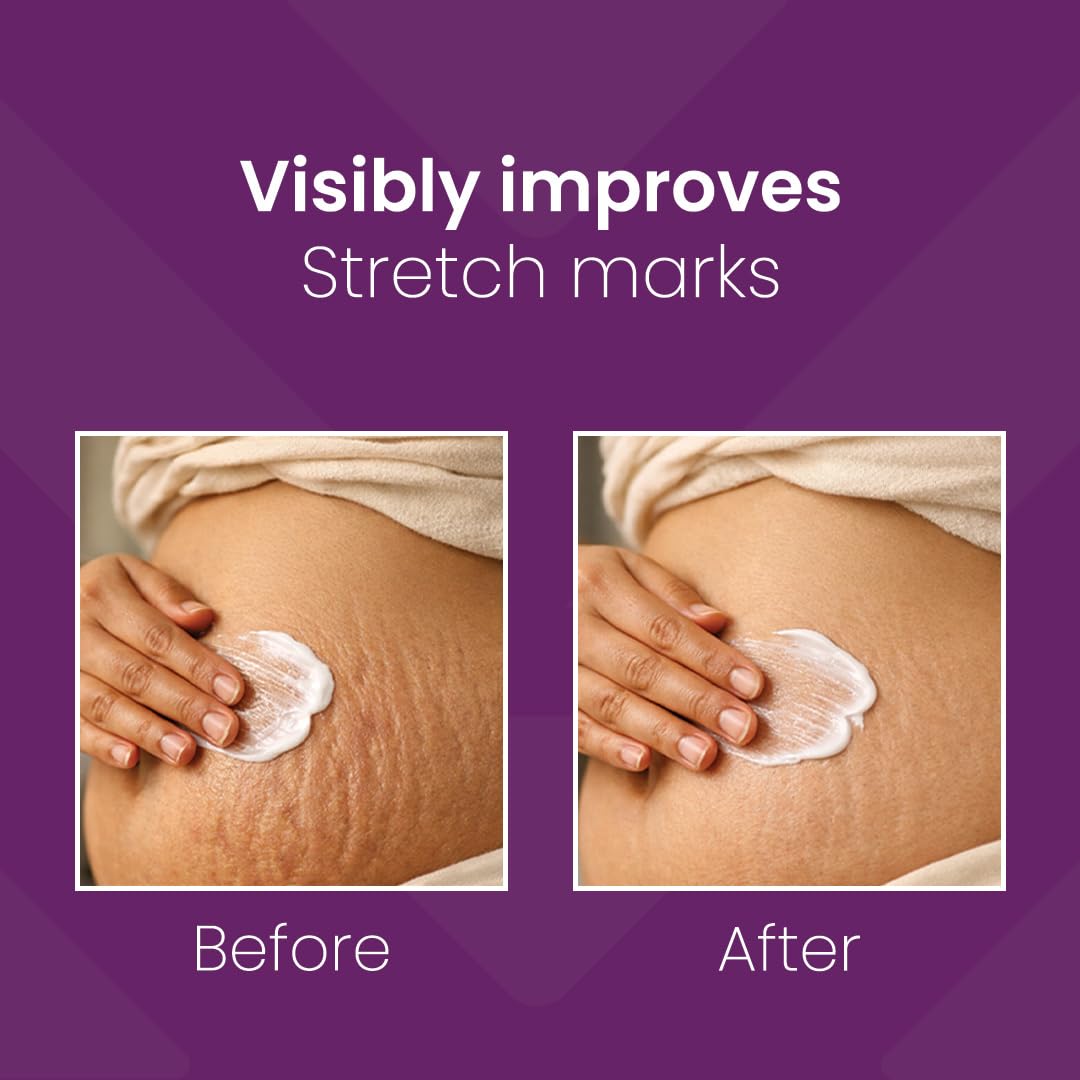 Mederma Cream Stretch Marks Therapy, 25g 1