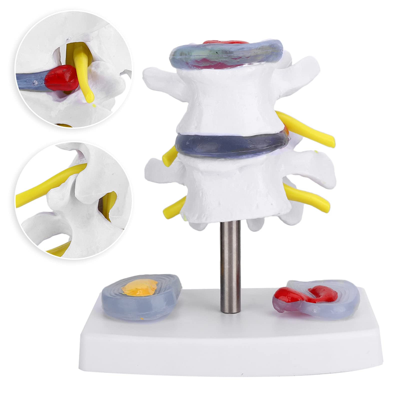 Modello di Vertebre Lombari Umane, Modello di Ernia del Disco Lombare Anatomico Umano con Base Staccabile Ottimo Modo per Dimostrare Il Disco