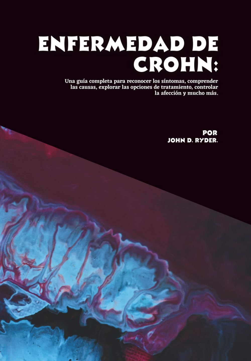 Enfermedad de Crohn: Una guía completa para reconocer los síntomas, comprender las causas, explorar las opciones de tratamiento, controlar la afección y mucho más