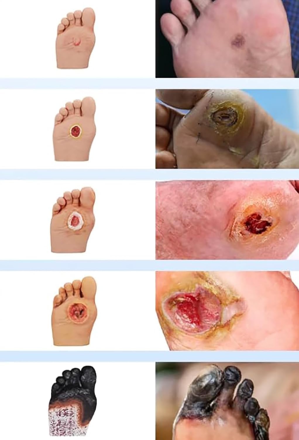 Model symulatora stopy cukrzycowej do demonstracji pielęgnacji ran, stopnia 1-5, ropne zmiany ran, narzędzie do anatomii i fizjologii, idealny do edukacji medycznej