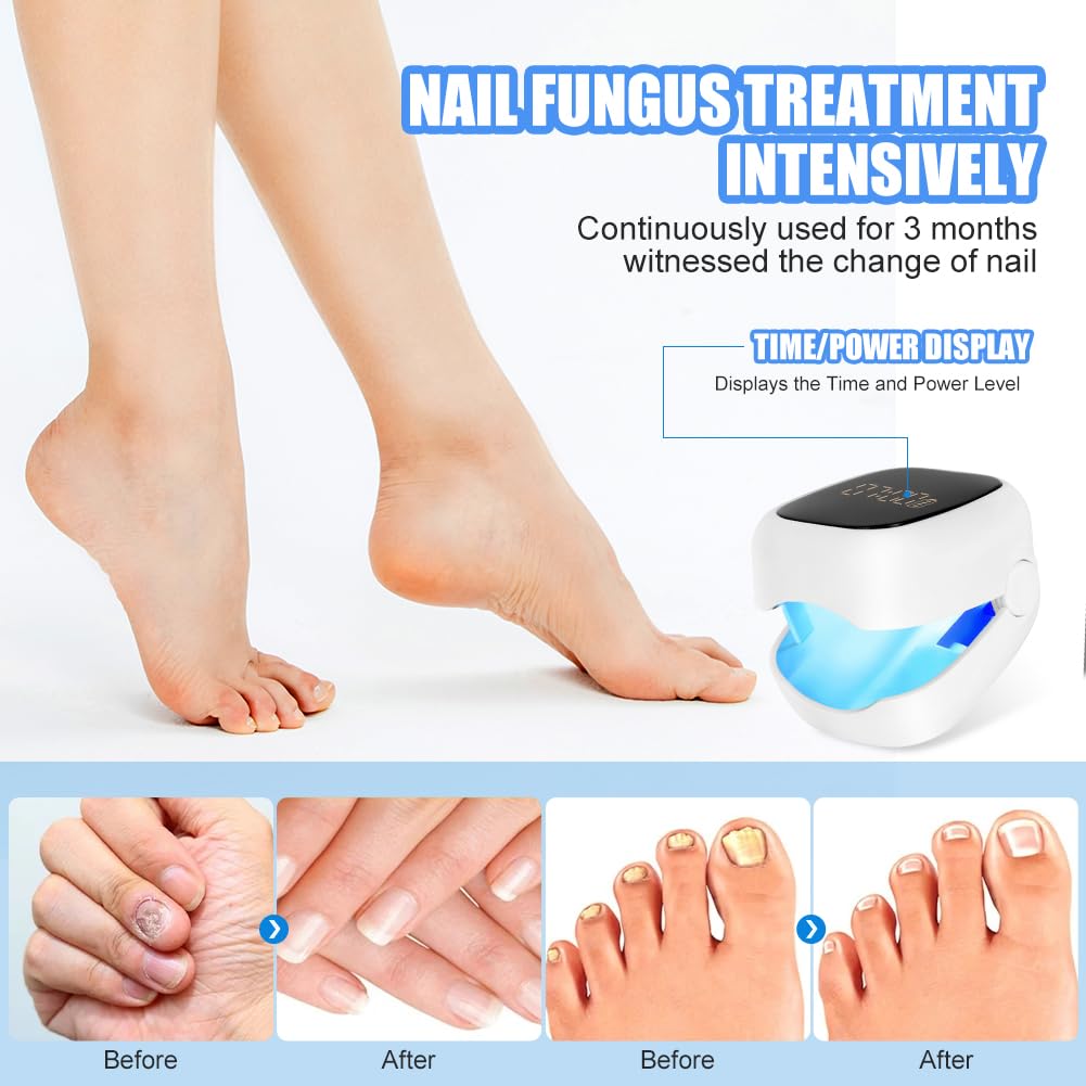 AOOWU Dispositivo de Limpieza de Hongos en Uñas, Profesional Dispositivo de Láser de Hongos Uñas Luz Invisible de 940nm y luz Azul de 500nm, Aparato de Tratamiento de Hongos de Uñas con Pantalla LED