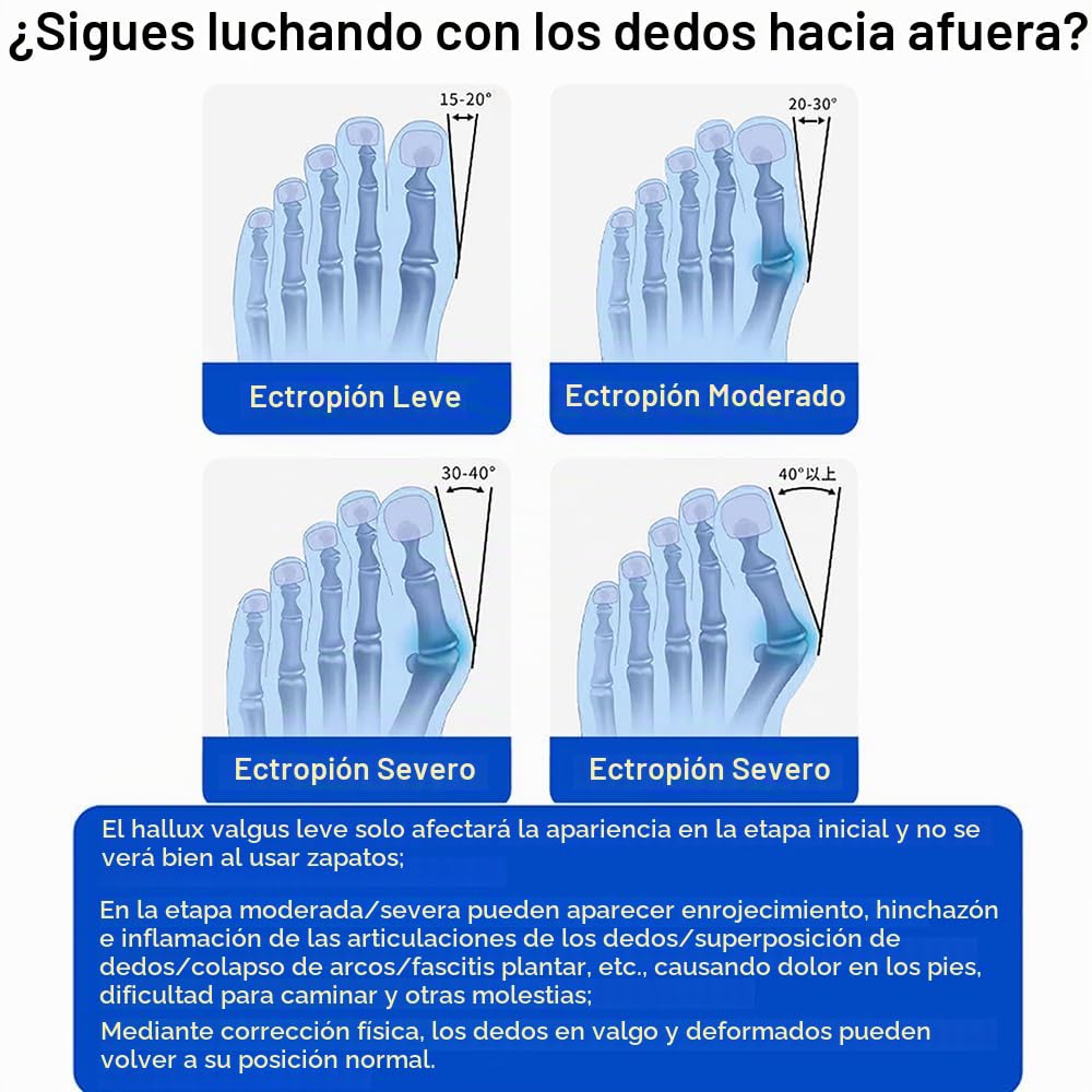 Corrector de juanetes para mujer, dedo gordo – alisador de dedos ajustable para alivio del hallux valgus, soporte de reparación de pies izquierdo y derecho