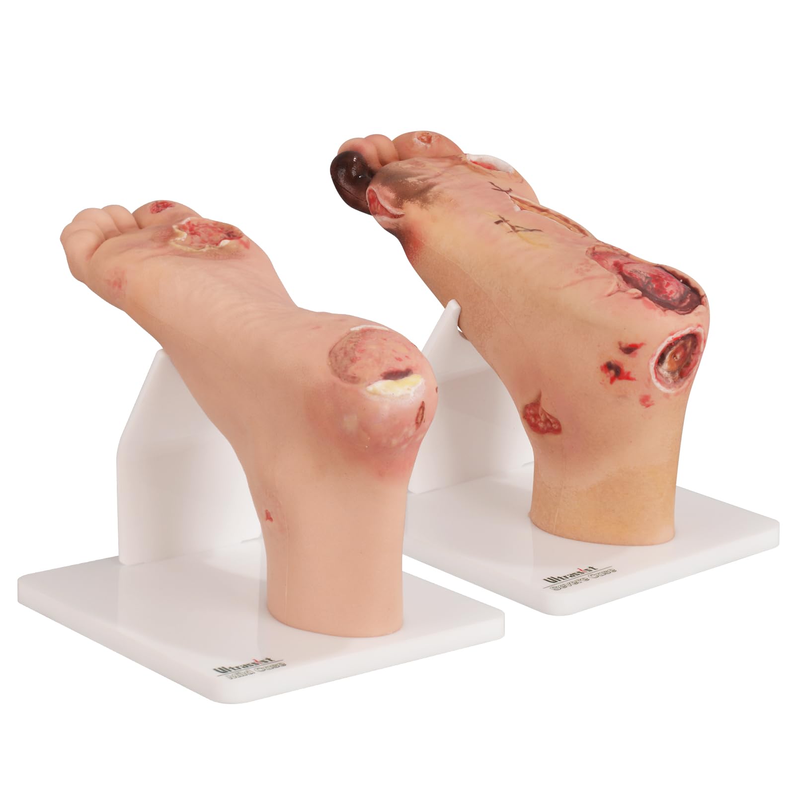 Photo 1 of Ultrassist Diabetic Foot Ulcer Model Set - Anatomical Accuracy for Mild & Severe Stage Pathology Study - Medical Training Tool for Healthcare Professionals