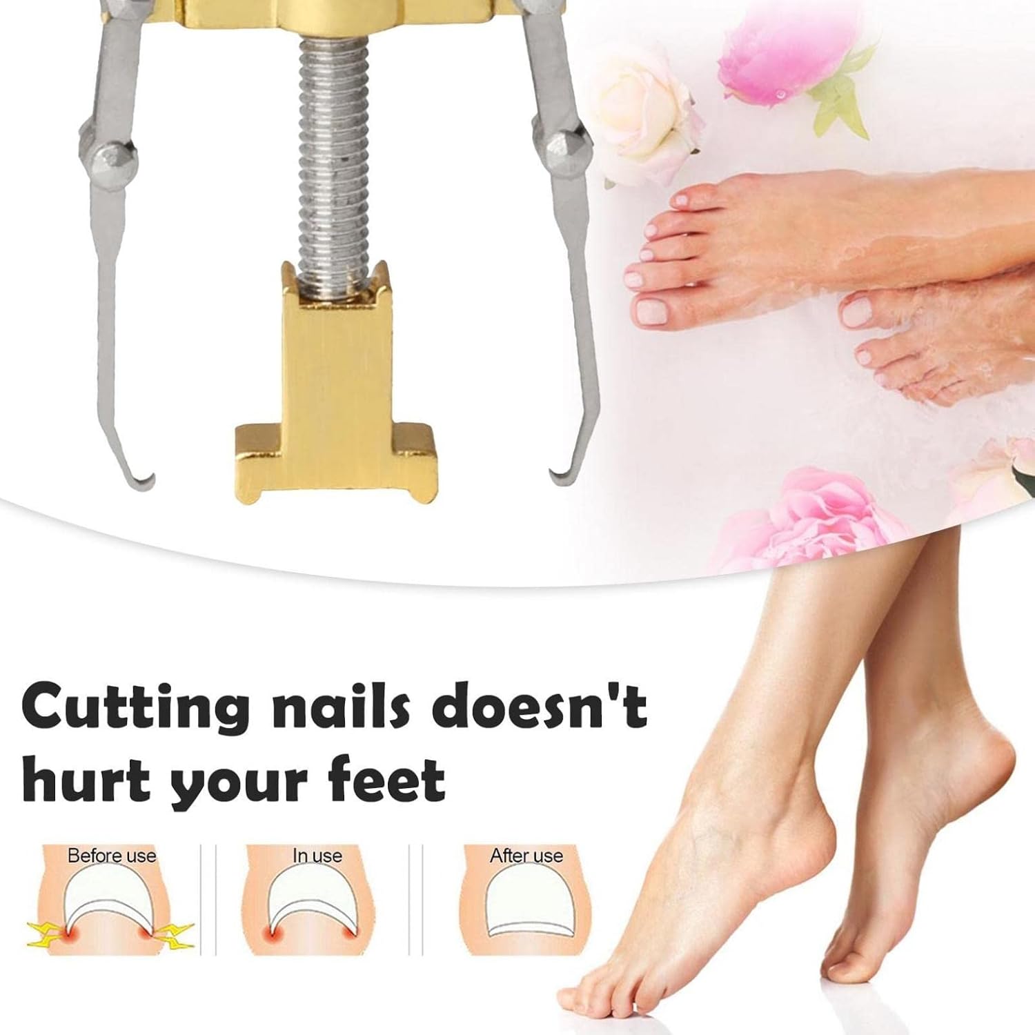 ZITIANY Nail Corrector, Ingrown Toenail Tool Toe Clamp Stainless Steel Foot Care Tool, Professional Ingrown Toenail Treatment Kit For Nail Correction, Softening And Easy Trimming : Beauty & Personal Care