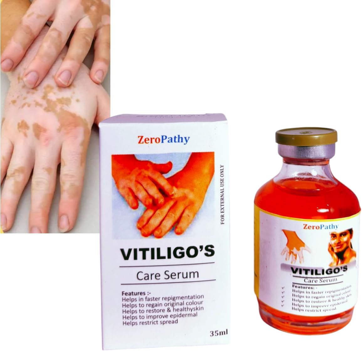 Vitiligo Care Oil and Cream For White Patches Treatment 35ml | Natural Herbal Ayurvedic Skin Color Restorer