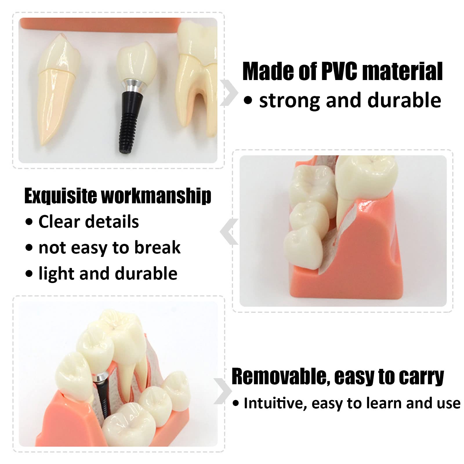 Amovible Modèle D'implant, Modèle Dentaire de Pont de Couronne, Modèle de Dent pour Aidant Le Dentiste et Le Patient à Communiquer et à Discuter du Plan de Traitement, Intuitif et Portable
