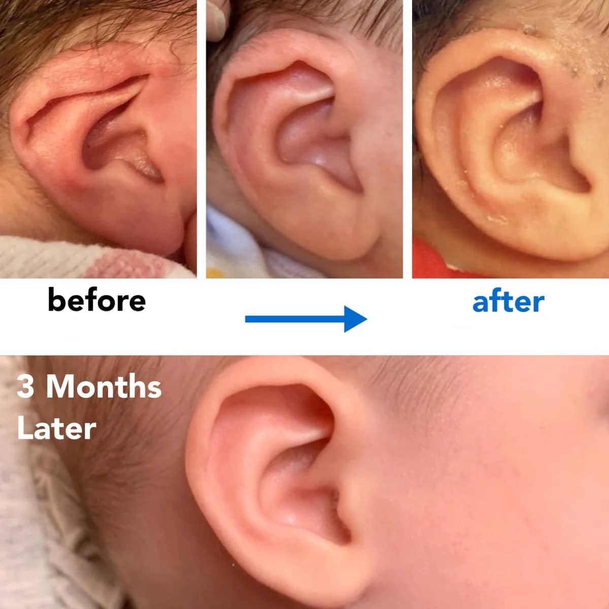 Infant Lop Ear Deformity Correction Clip For Newborn Baby Fixing Auricle Valgus Patch Stickers Children Ear Shape Aesthetic Corrector Without Surgery product thumbnail 8