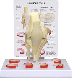 GPI Anatomicals 1010 Modello di Menisco con 6 Lesioni