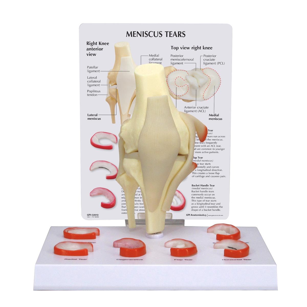GPI Anatomicals Modelo de rodilla, menisco con 6 desgarros