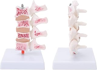 Osteoporosis Vertebrae Anatomical Model, Professional Osteoporosis Model Human Anatomical Spine Model For Teaching Demonstration