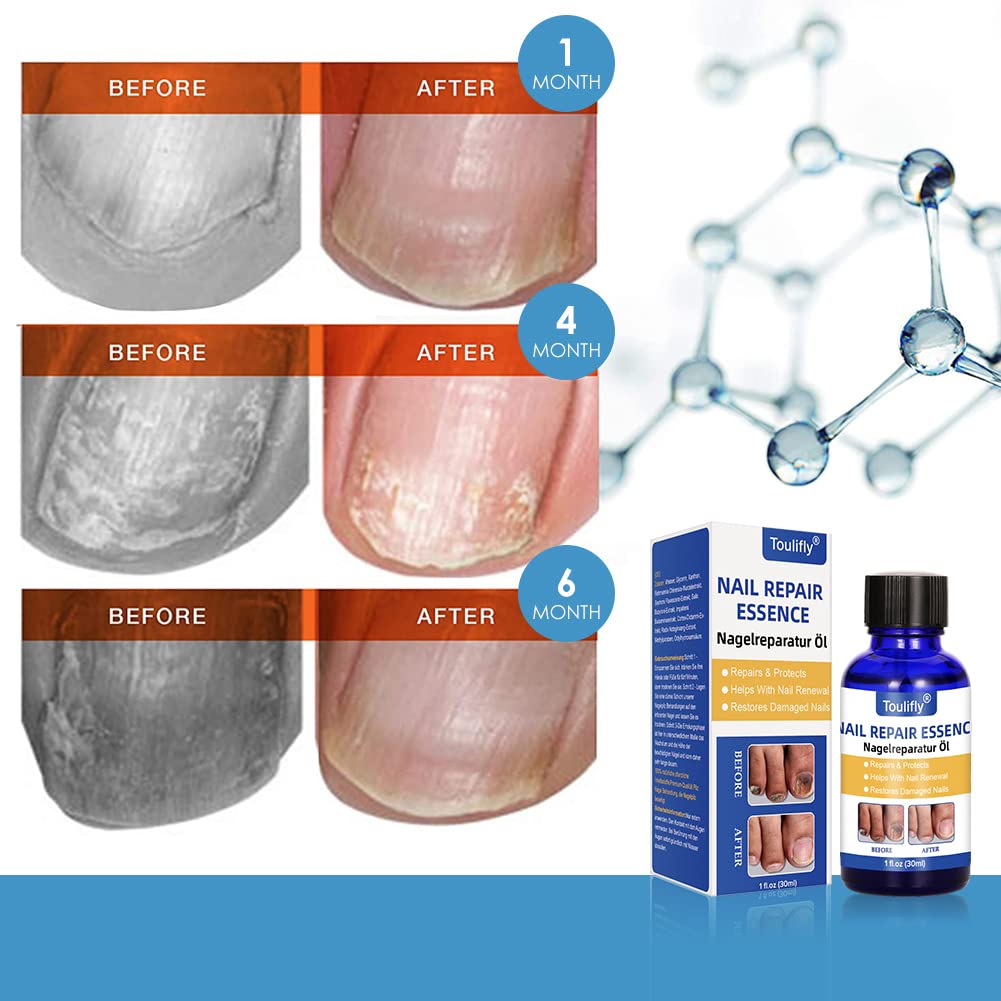 Nail Fungus Treatment for Toenail, Toenail Fungus, Nail Fungus