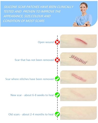 Miniatura 5 de Hojas de silicona para cicatrices, cinta de silicona para cicatrices, rollo de 1.6 x 60 pulgadas, tratamiento de eliminación de cicatrices, cinta de