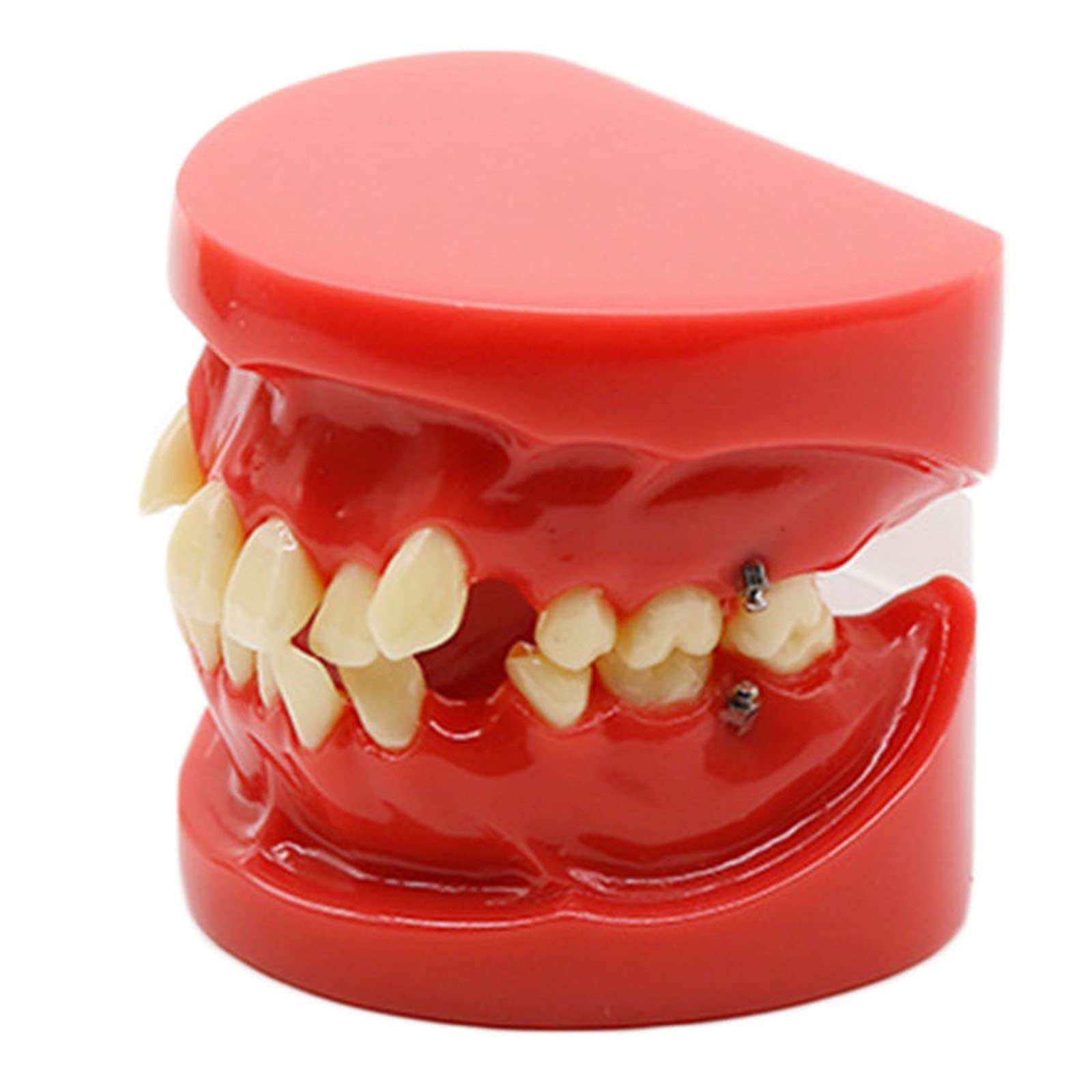Modèle De Dents Orthodontiques - Modèle De Dent Mal Positionnée Conforme Aux Normes Médicales - Modèle De Dents Orthodontiques - Modèle Pédagogique De Dents Sim