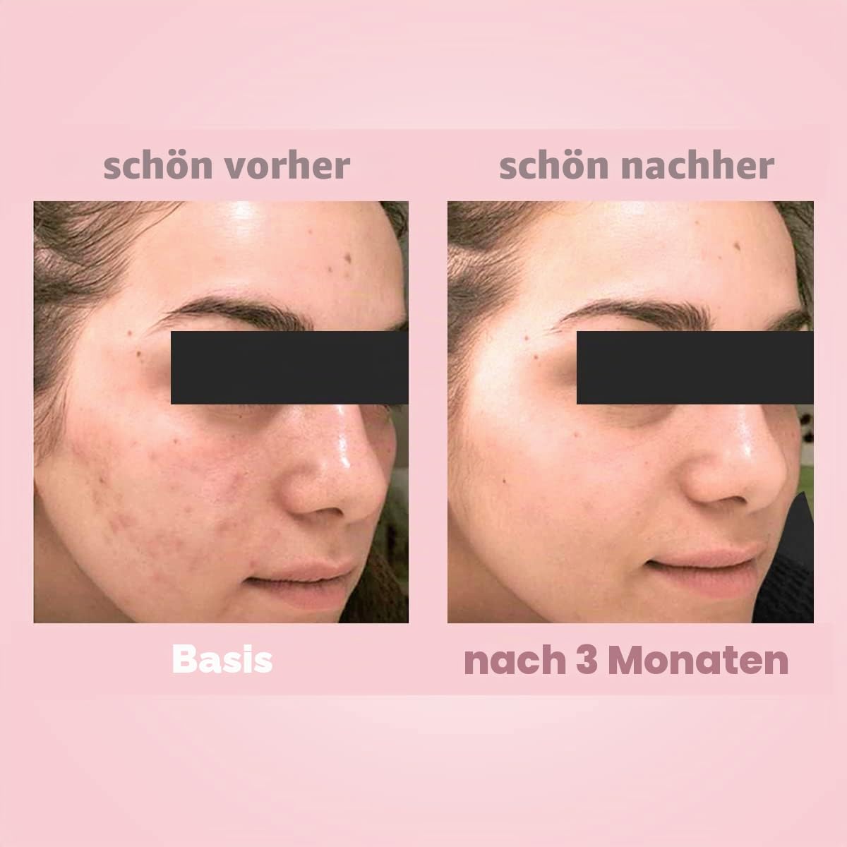3 Einfache Stufen Für Gesunde Haut Keine Akne Beseitigt Pickel Mitesser von Biotrade