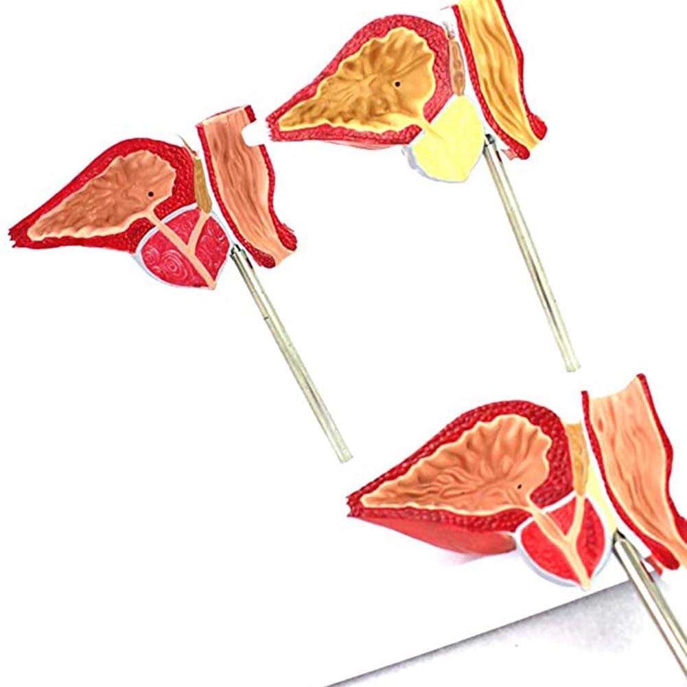 Human Anatomical Prostate Model -1: 1 Life-Size Prostate Model PVC Material Normal and Injured Representation Human Anatomy Science Models