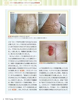 WOC Nursing 2022年2月 Vol.10No.2 特集:ストーマ造設から看取りまで