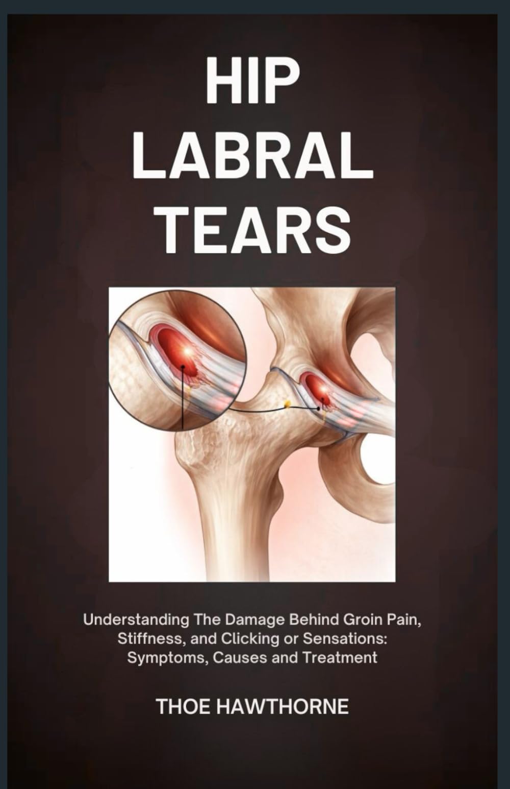 Hip Labral Tears: Understanding the Damage Behind Groin Pain, Stiffness, and Clicking or Locking Sensations: Symptoms, Causes, and Treatment
