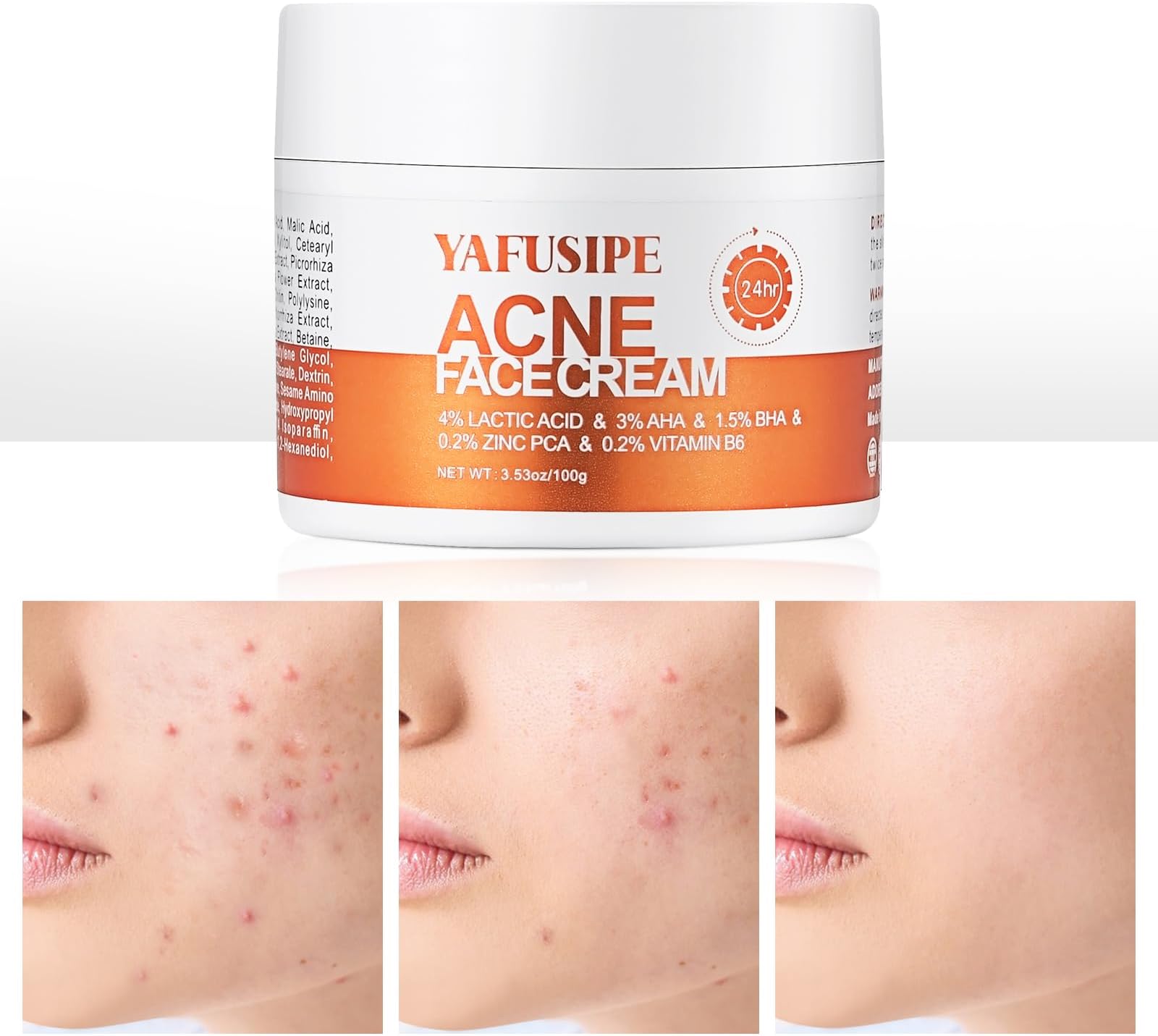 Acne Treatment for Face for Hormonal Cystic Stubborn Acne Cream for Sensitive Skin Teens Adults Women Men Spot Pimple Butt Control Rapid Clearing Breakout Overnight Face Blemish Treatment