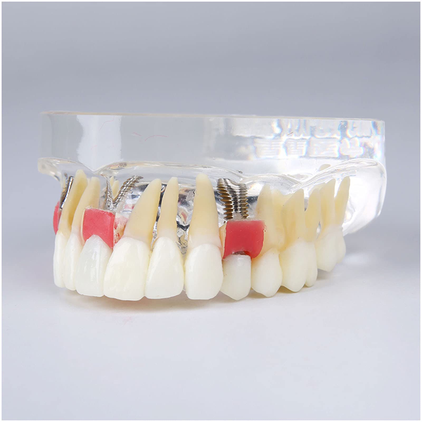 Modèle D'implant De Dents - Modèle De Restauration Supérieure De La Surventure De L'implant Dentaire - Modèle D'étude des Dents Dentaire avec Pilier, Ongle D'implant, Gomme Douce