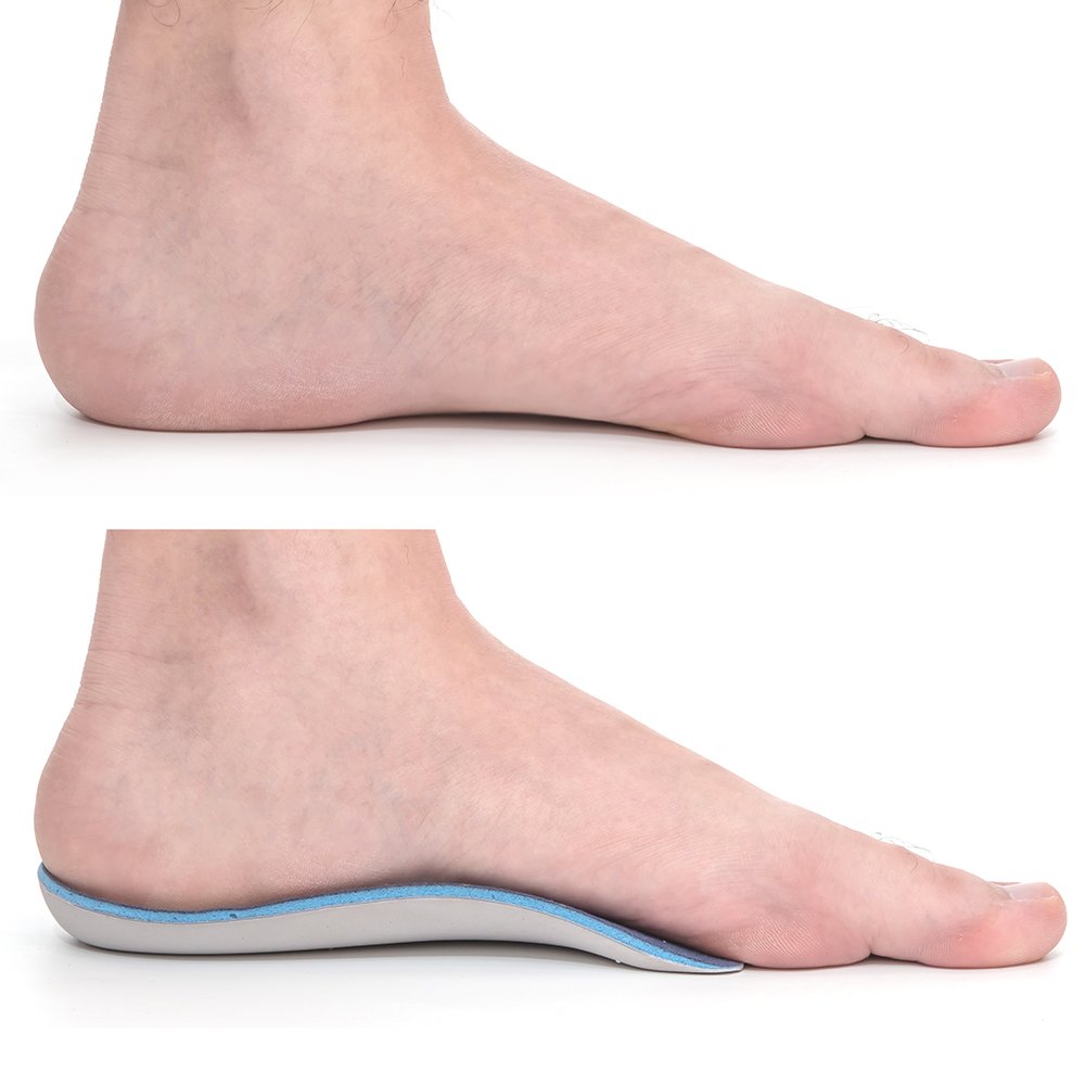 Collapsed Arches Flat Feet How To Tell The Difference Custom Orthotics