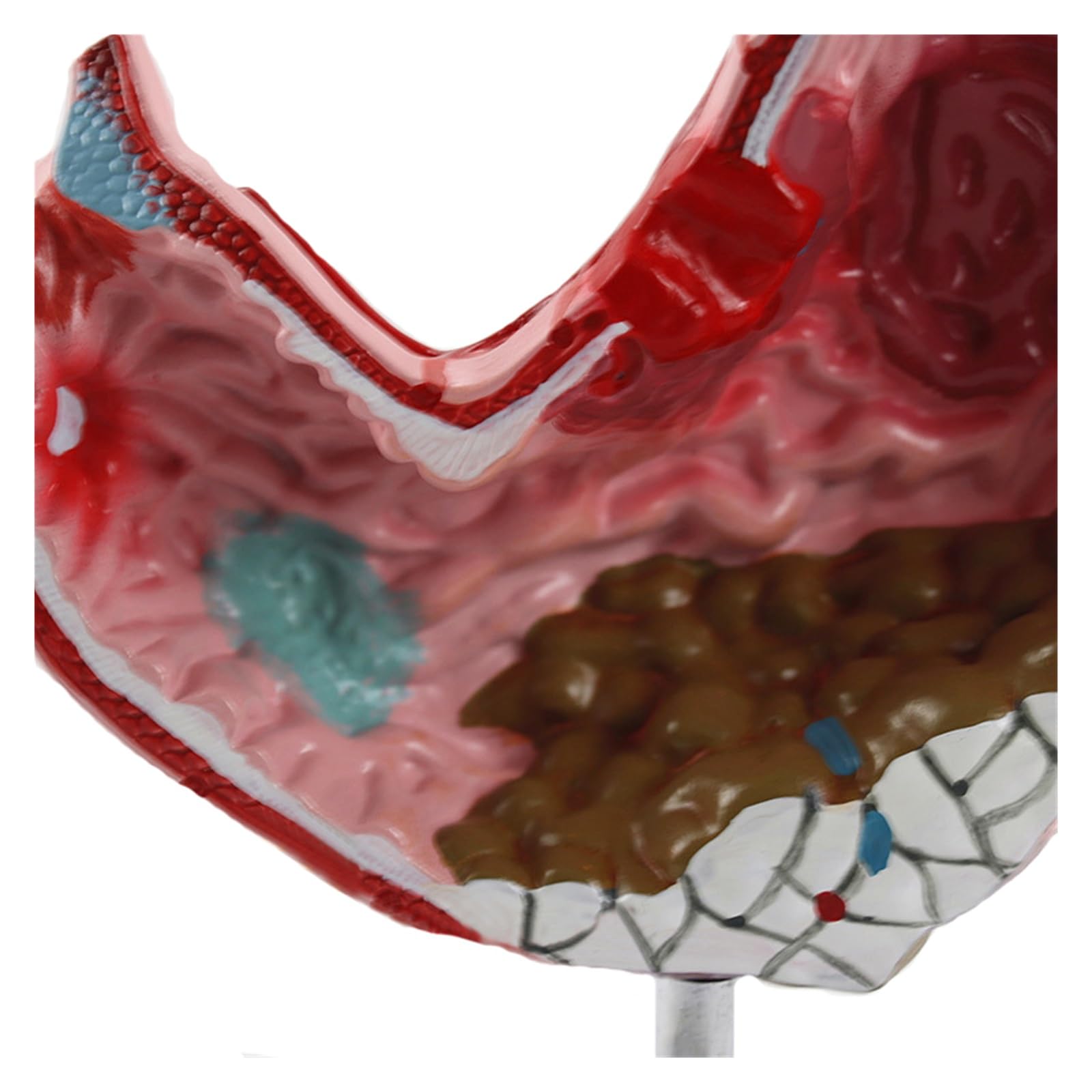 Humano EN Anatomía estomacal patológica Modelo de demostración del estómago Ayuda médica SIDA