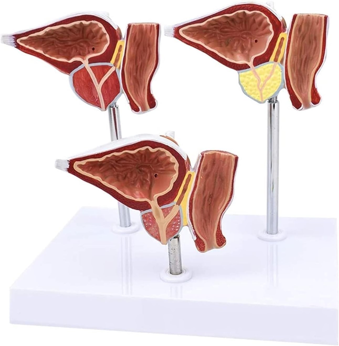 Home Office LAErper Teaching Model Life Size Prostate Model Normal And Lesion Presentation Prostate Compare Models Human Anatomy Science Models (Size : 26x18x15cm) Anatomy Biology (Size : 26 X 18 X 15