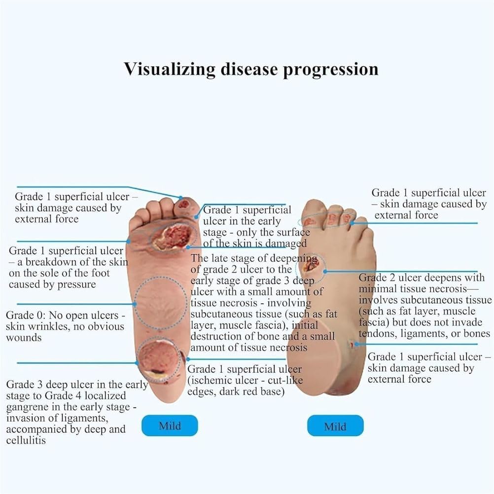 Teaching Model,Diabetic Foot Ulcer Model Set - Anatomical Accuracy for Mild & Severe Stage Pathology Study-Medical Training Tool for Healthcare Professionals