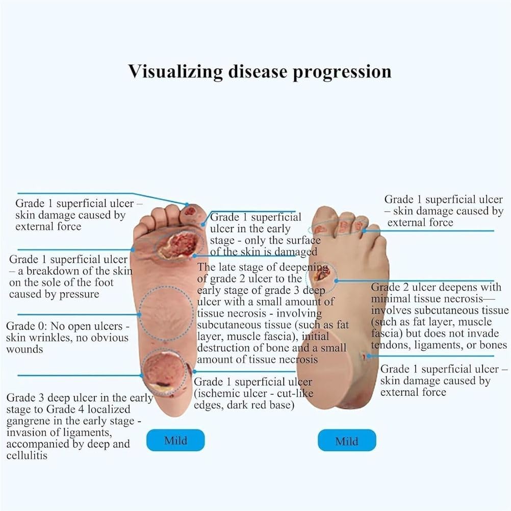 Model dydaktyczny, zestaw modeli owrzodzeń stopy cukrzycowej - dokładność anatomiczna dla łagodnych i ciężkich stadiów patologii, narzędzie do nauki i szkolenia dla pracowników służby zdrowia