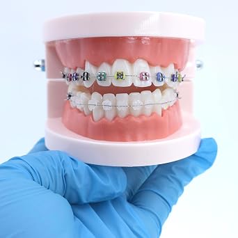 Dental Teaching Model Standard Dental Orthodontic Teeth Model with Braces Half Metal/Half Ceramic Orthodontic Brackets for Dentistry Education Study