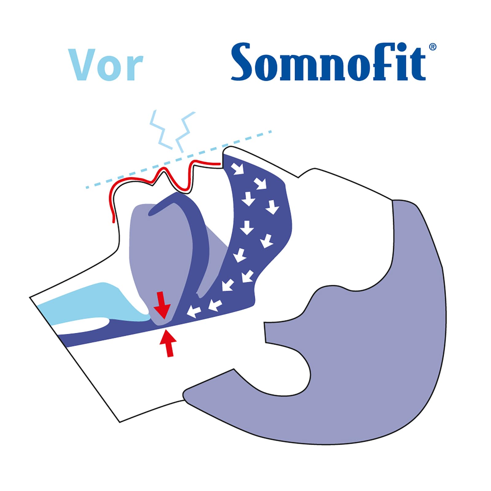 Premium Anti-Schnarchschiene SomnoFit - mit Ergänzungsset Nasenspreizer - Top-Snorestoppers gegen Schnarchen - (SomniShop Set)