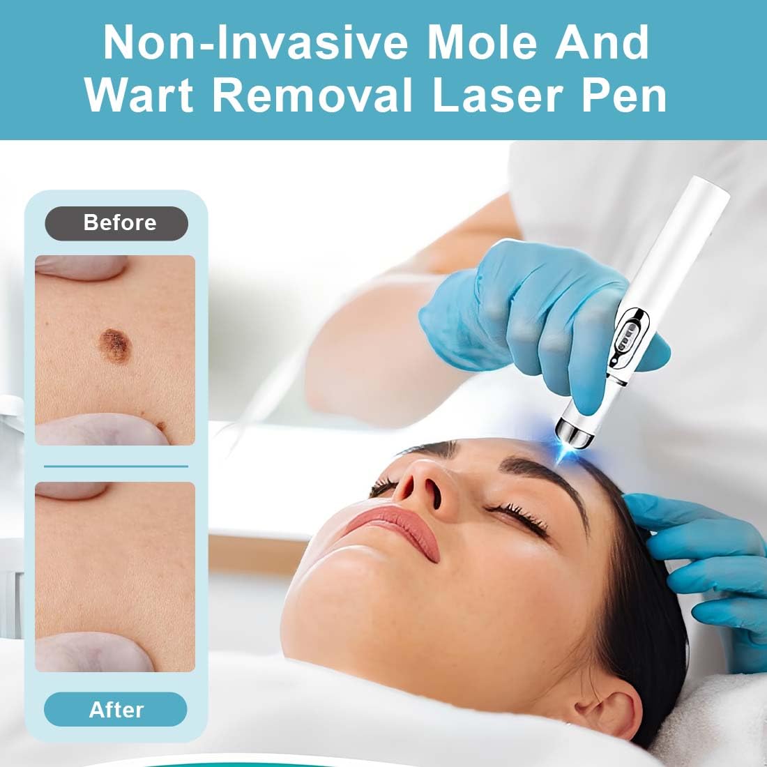 1 Pezzo Penna per Acne a luce Blu, Penna Talpa a Punto laser e Verruche, Per Eliminare l'acne, Per Viso e Corpo