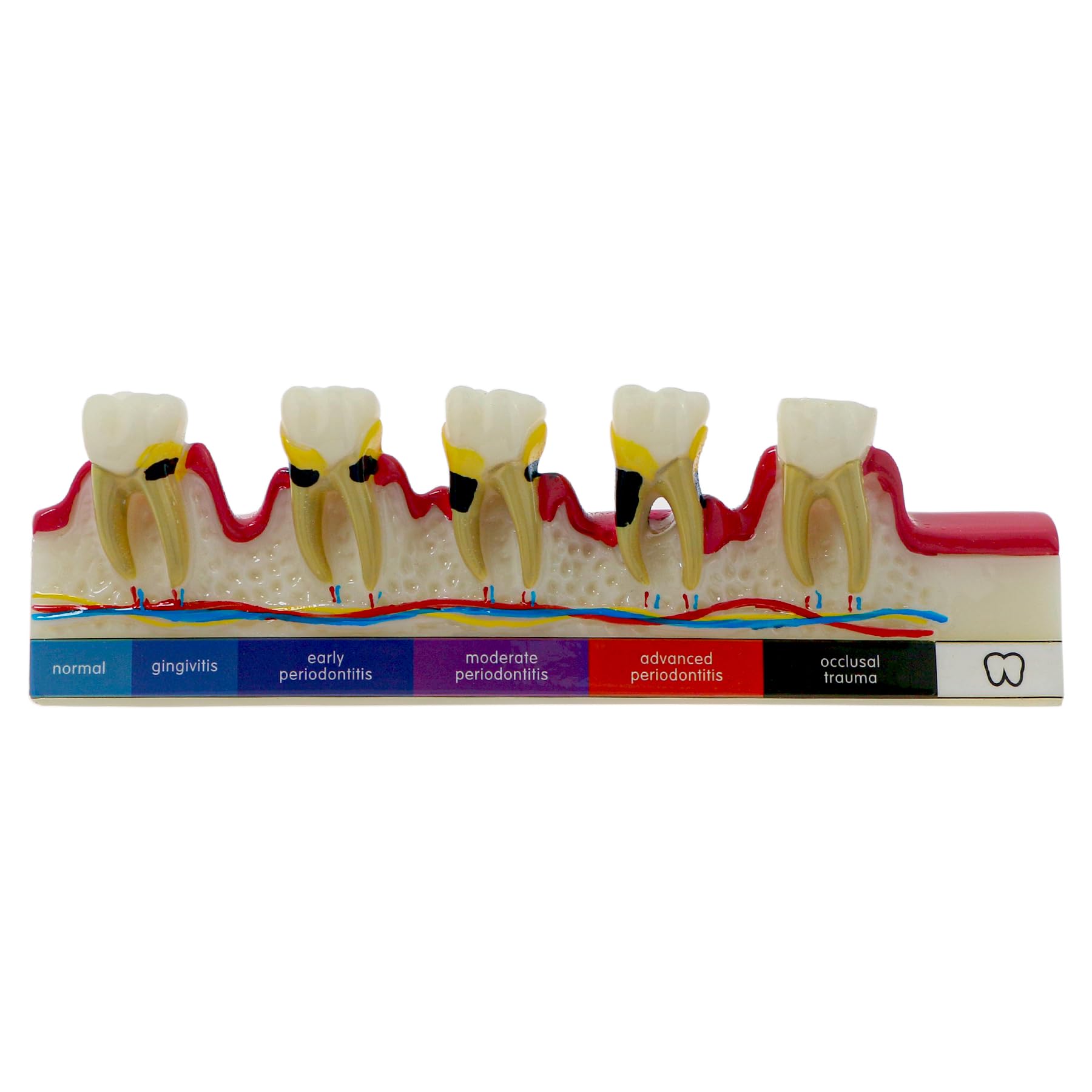Dental Teeth Model 6-Stage Periodontal Disease Demonstration Model for Dental Education