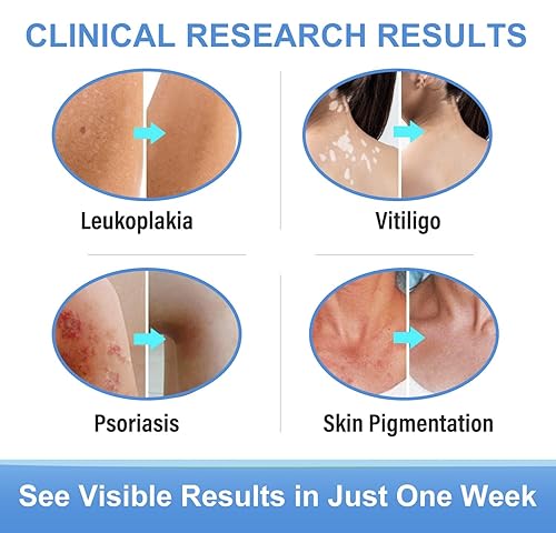 Miniatura 6 de Yakitoko Tratamiento de vitíligo, crema de vitíligo mejora la pigmentación de la piel y reduce las manchas blancas, adecuado para vitíligo de la