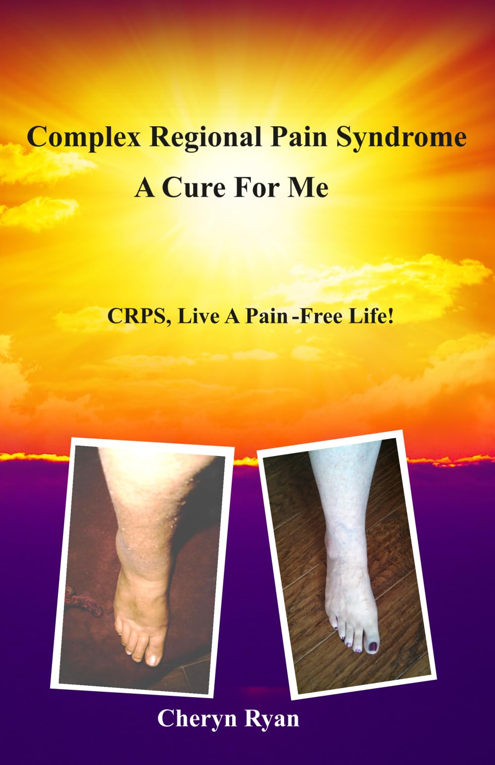 COMPLEX REGIONAL PAIN SYNDROME A CURE FOR ME: CRPS, LIVE A PAIN-FREE LIFE!