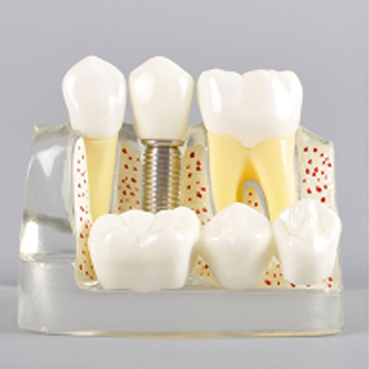 Modello Dentale di Dentista, Modello di impianto Dentale, Materiale in Resina Rimovibile utilizzato per la Ricerca in Clinica odontoiatrica e per la Comunicazione Medico-paziente.