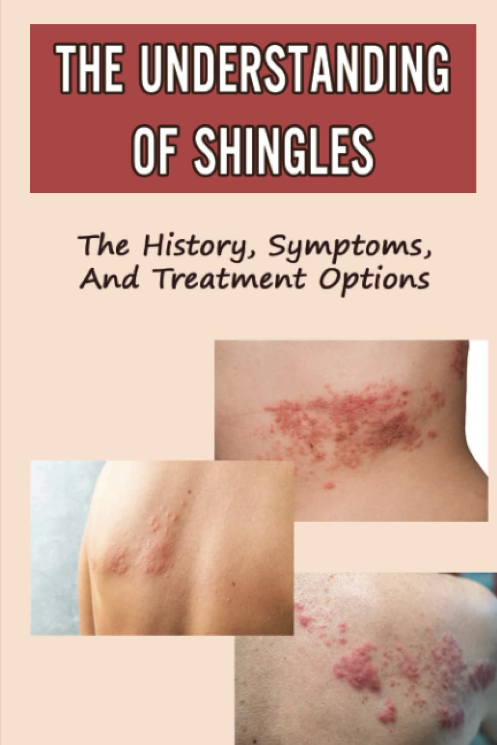 The Understanding Of Shingles: The History, Symptoms, And Treatment Options