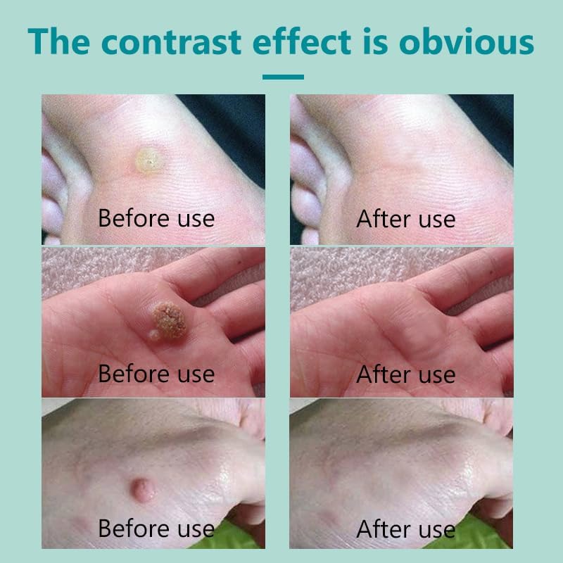 Miniatura 5 de Eliminación de acción rápida para hombres y mujeres, congelación de verrugas para verrugas plantares, verrugas comunes, verrugas planas, maíz