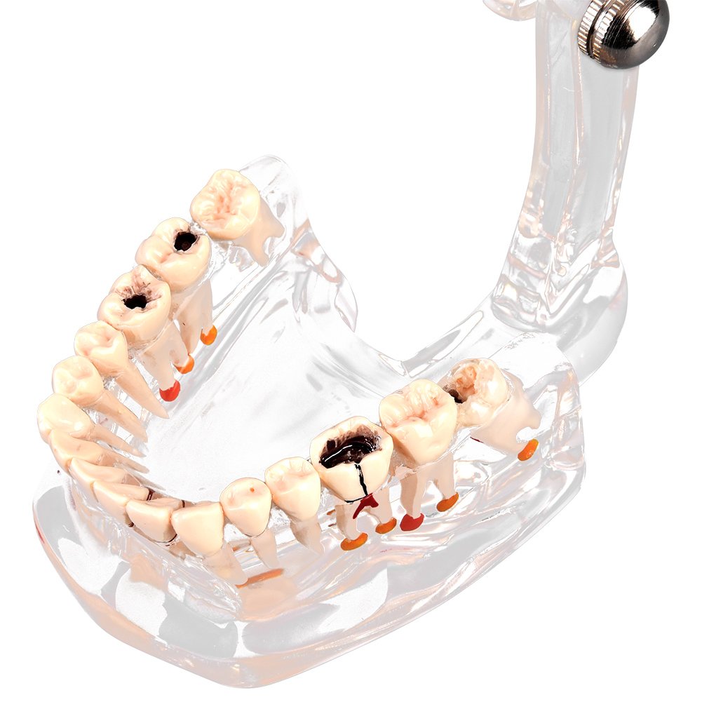Walfront Modèle de Dents Amovibles, Transparent Dentaire Implant Disease Enseignement Étude Standard Dents Modèle Démonstration Pathologique