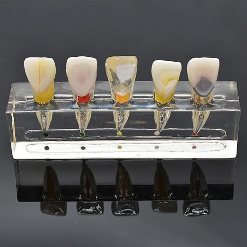 Miniatura 9 de Modelo patológico de restauración de pulpa dental de diente frontal, modelo endodóntico humano