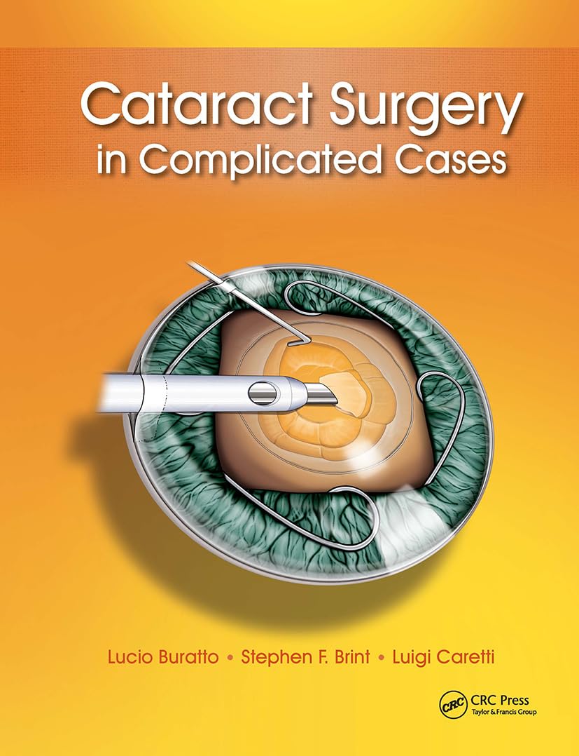 Cataract Surgery in Complicated Cases 1st Edition