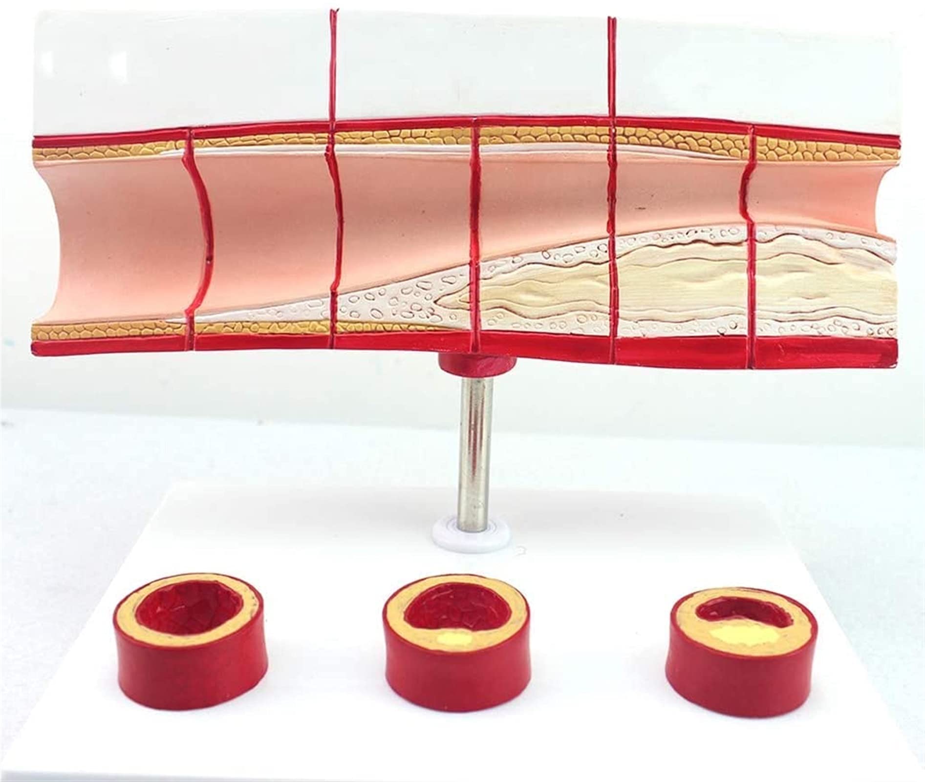 Modele medyczne, model anatomii procesu zakrzepicy, model cholesterolu sercowo-naczyniowego, choroby serca, anatomiczny model cholesterolu we krwi, modele medyczne i materiały edukacyjne model