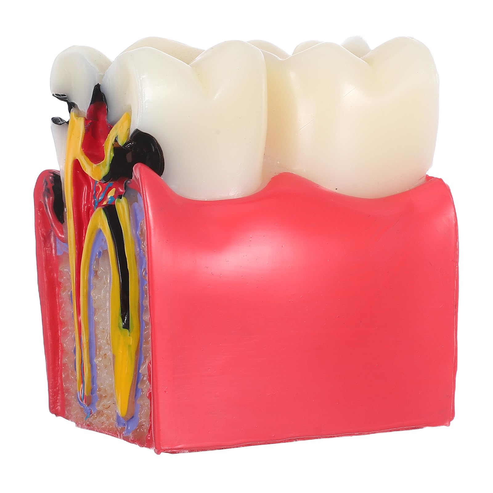 BESTYASH Modèle Pédagogique de Caries Dentaires à 6x Grossissement en Résine, Outil Typodont D'anatomie Comparée Dents Saines Vs Cariées, pour Enseignement en École et Cabinet