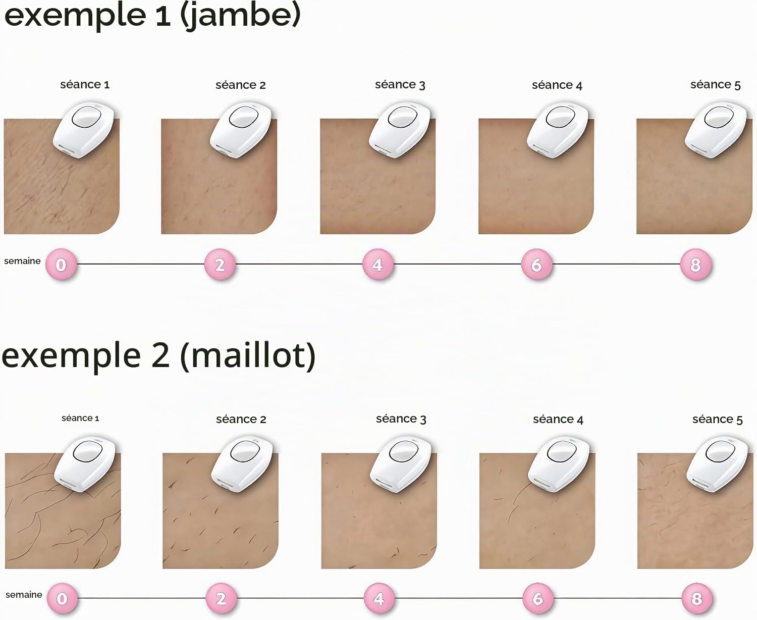 Solippy Loop Epilateur Laser,Épilation Laser Indolore,Pour Épilation Définie Du Visage, Corps, Bikini Et Aisselles (Rose)